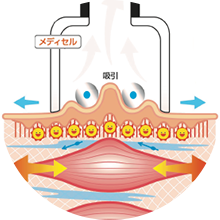皮膚を吸引して結合組織の循環を促す
